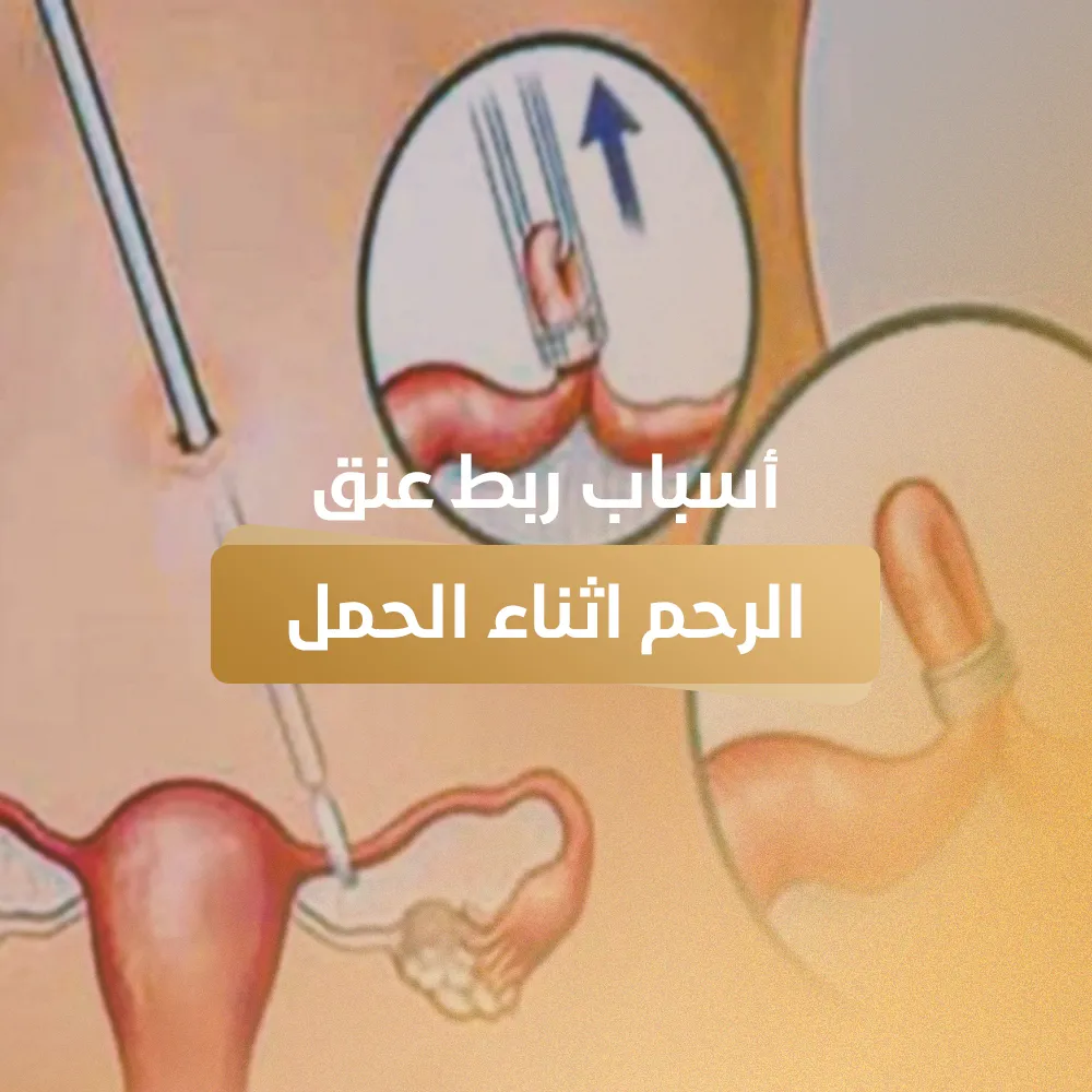 أسباب ربط عنق الرحم أثناء الحمل