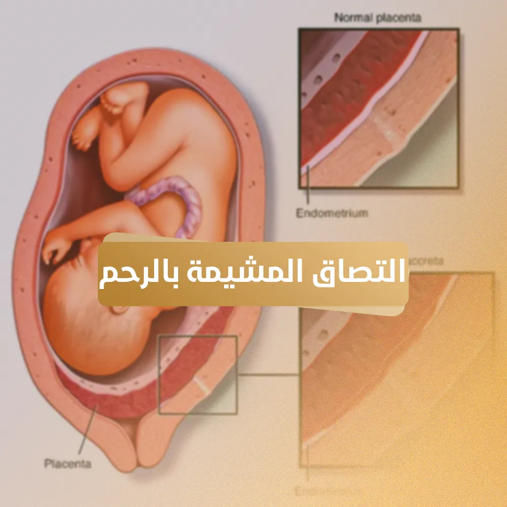 التصاق المشيمة بالرحم