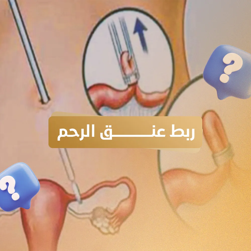 ربط عنق الرحم
