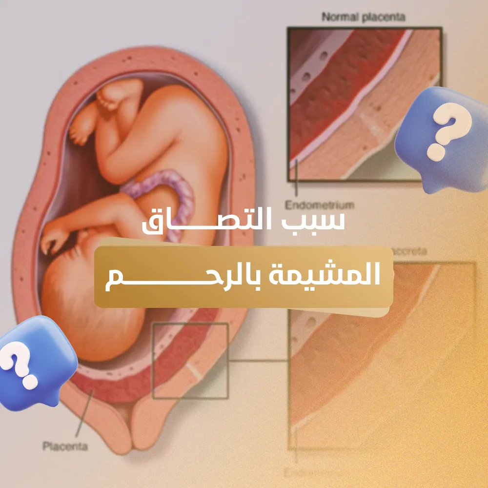 سبب التصاق المشيمة بالرحم