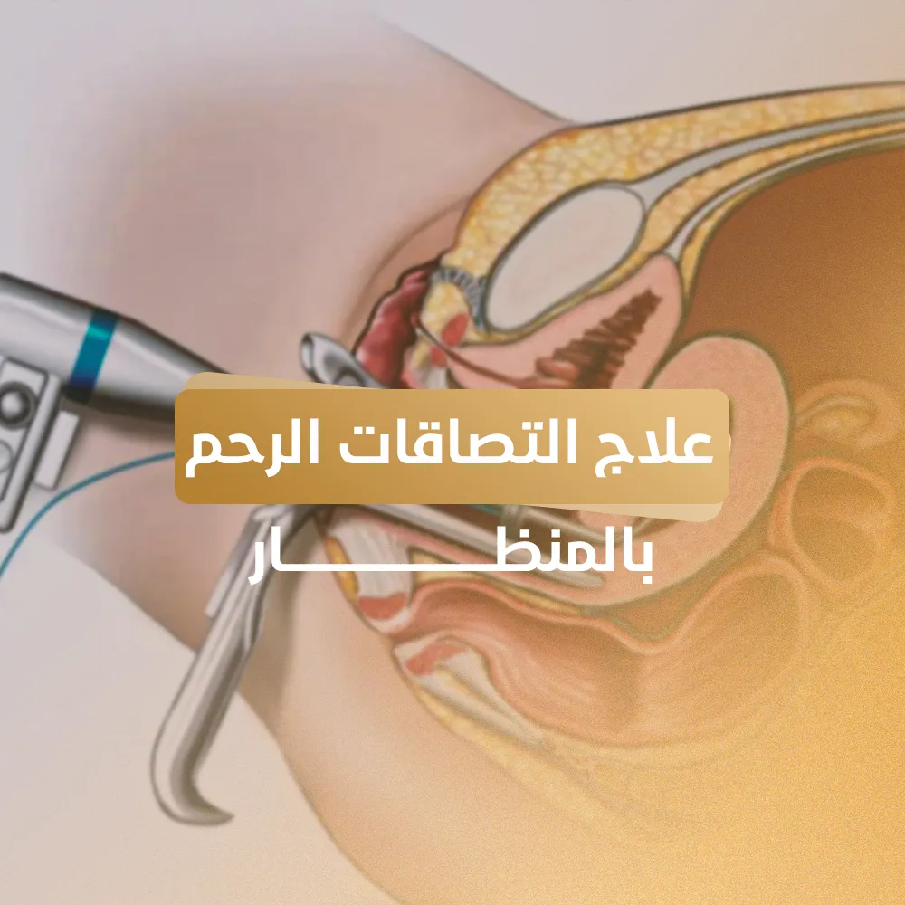 علاج التصاقات الرحم بالمنظار